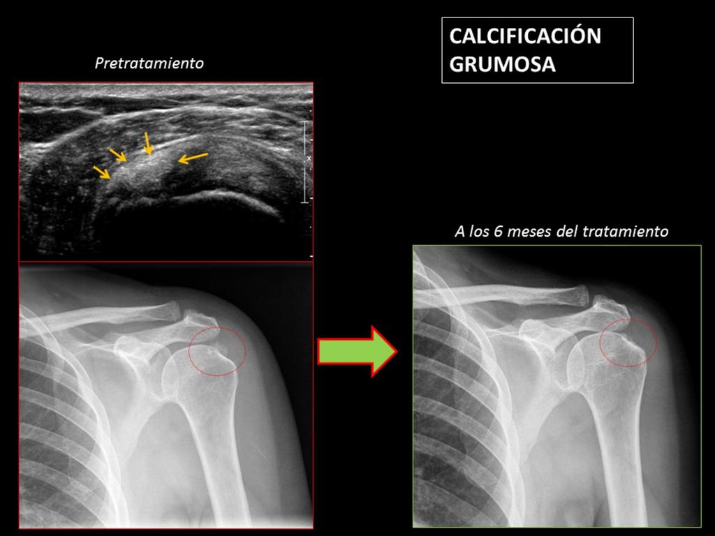 Fig. 7: Imágenes de ecografía y radiografía AP de hombro izquiedo pretratamiento, que muestran una calcificación grumosa (flechas amarillas) en el tendón