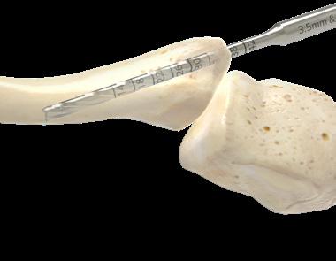 Esta broca es recomendable ya que puede ayudar a disminuir los efectos de la variación de la densidad ósea y la tracción al insertar el tornillo.
