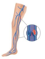 Coágulos de sangre. Los coágulos de sangre en las venas de la pierna son la complicación más común de la cirugía de reemplazo de rodilla.