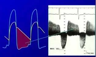 Doppler continuo: Tpo de hemipresión -Pro: simple, disponible en ETT y ETE, reproducible -Con: afectado por la complacencia aortica y VI y la TA La velocidad del chorro regurgitante, refleja el