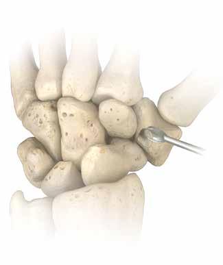 La incisión puede extenderse proximalmente para permitir el acceso al radio distal para el injerto óseo suplementario.