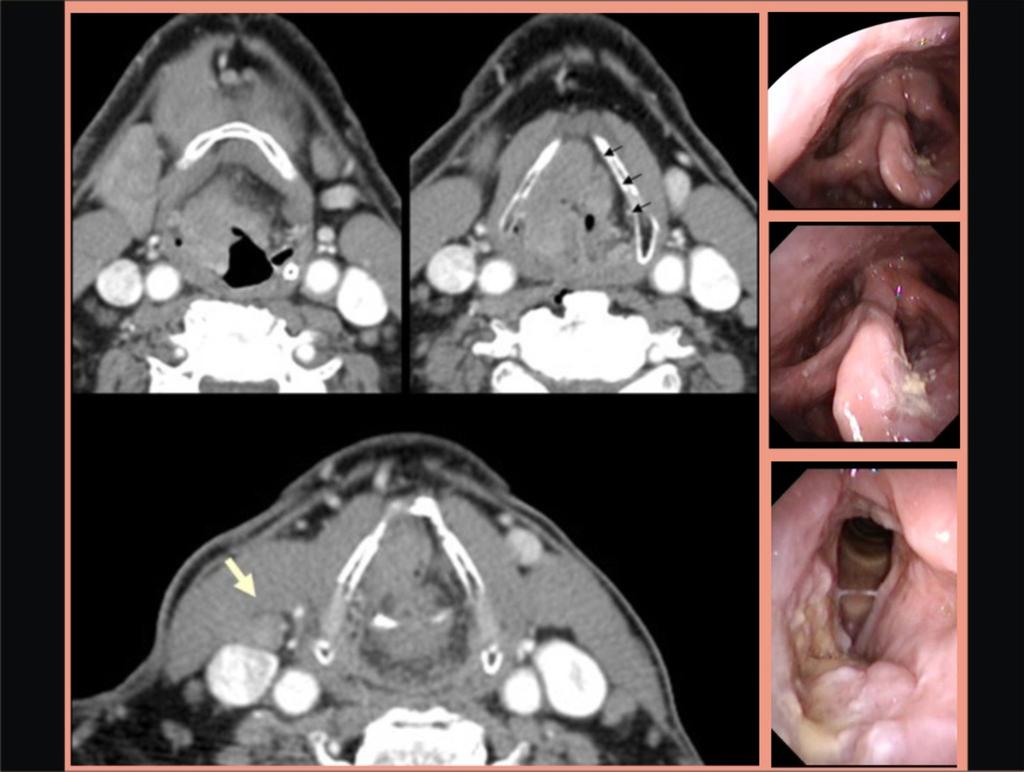 Fig. 4: Tumor supraglótico T3. En laringoscopia tumor de cara laringea de epiglotis con descenso anterior a banda derecha hasta ventrículo. Repliegue aritenoepiglotico derecho engrosado.