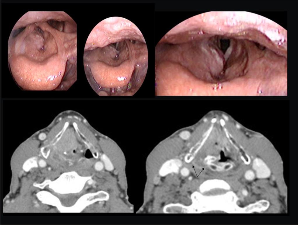 Fig. 6: Tumor supraglótico T3 En laringoscopia tumoración de aspecto neoplásico friable que ocupa banda derecha y cuerda derecha con