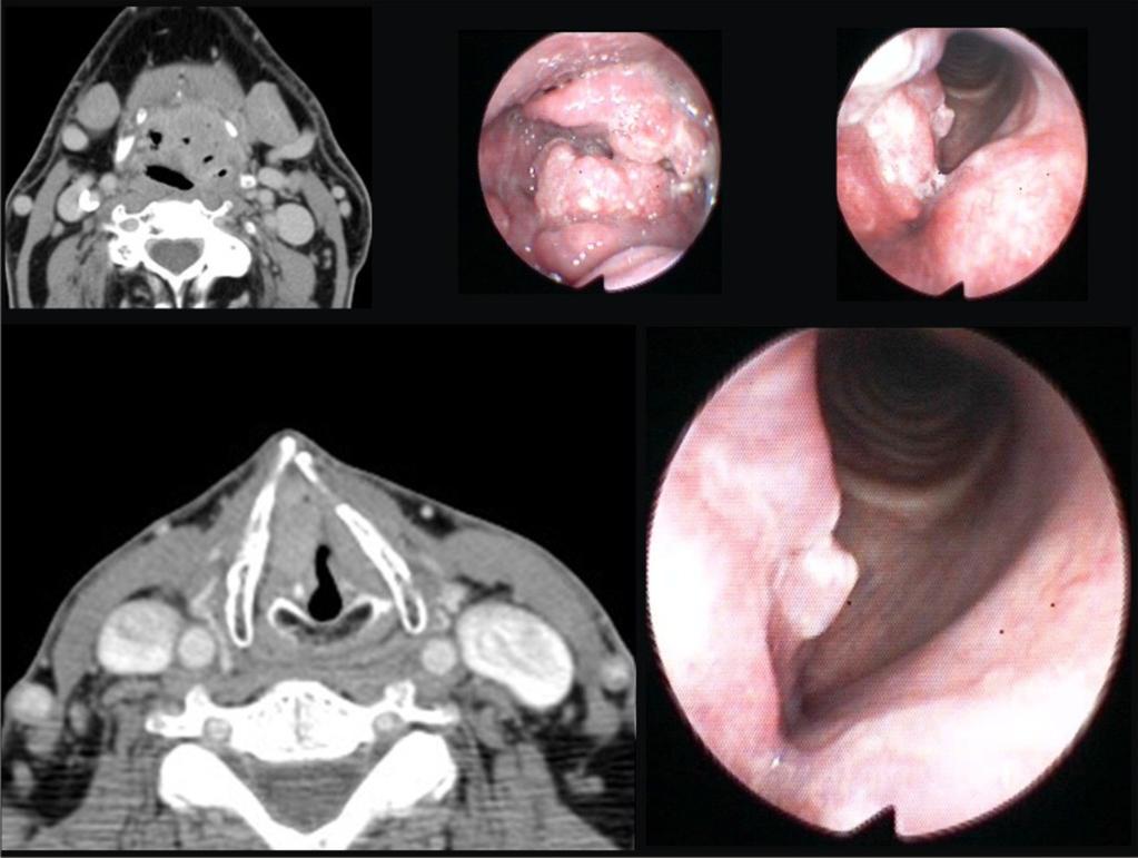 Fig. 10: Tumor glótico T2 En laringoscopia lesion ulcerovegetante en banda derecha, ventriculo y cuerda vocal derecha que conserva movilidad.