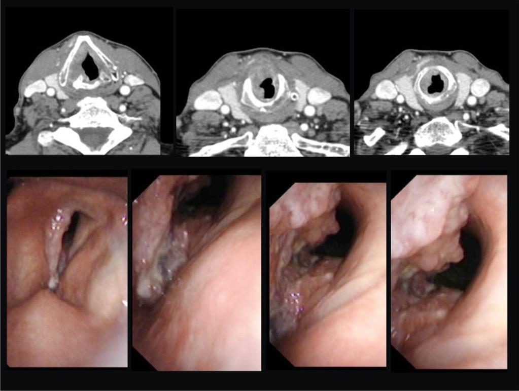 Fig. 11: Tumor glótico-subglótico T4 En laringoscopia tumoración en toda la extensión de cuerda vocal derecha y comisura anterior de se extiende ampliamente a subglotis en lado