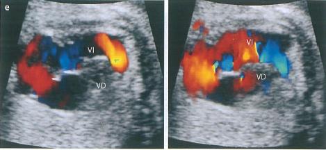 Diagnóstico prenatal Corte de 4C con doppler: flujo bidireccional Lai W et