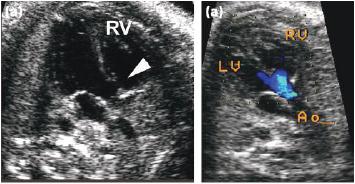 Diagnóstico prenatal Tracto de salida de VI: CIV subarteriales (alineada) Lai W