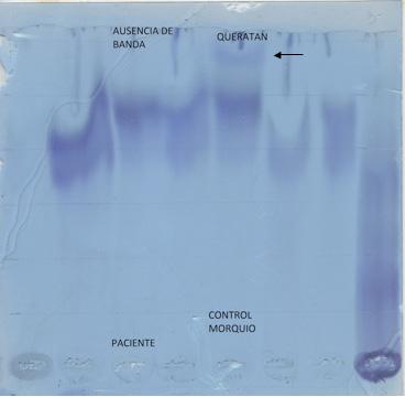 Imagen 11: Análisis de glicosaminoglicanos en orina por cromatografía en capa fina tras 1 año en terapia enzimática.