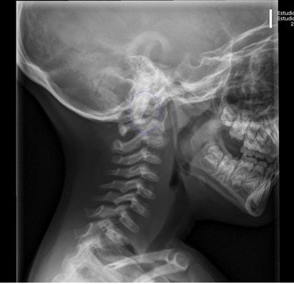 Imagen 6: Radiografía lateral de columna cervical. Estrechamiento de los cuerpos vertebrales.
