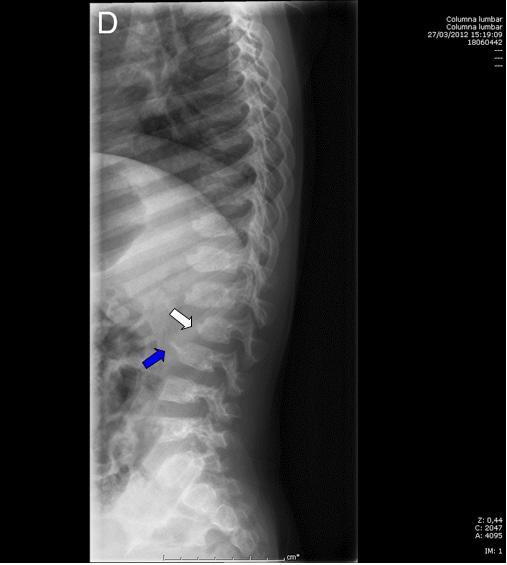 a inestabilidad atlantoaxial. Imagen 8: Radiografía AP de pelvis (incluyendo fémures).