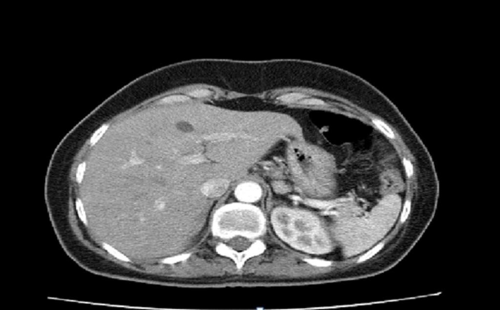 Images for this section: Fig. 1: Hígado de paciente con metástasis por cáncer de mama.