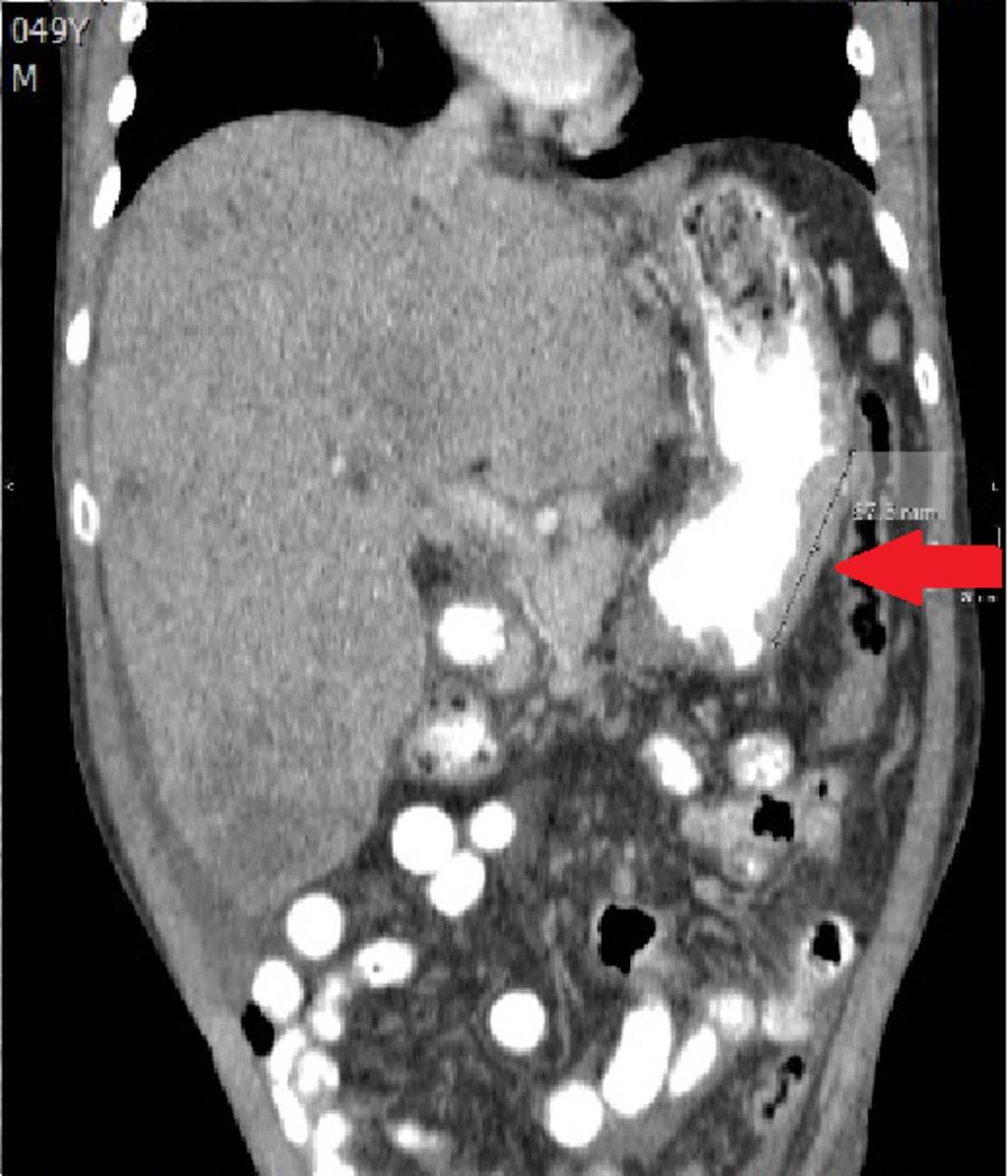 Fig. 5: En este caso el adenocarcinoma gástrico difuso se presentó como múltiples engrosamientos, el más llamativo tenía