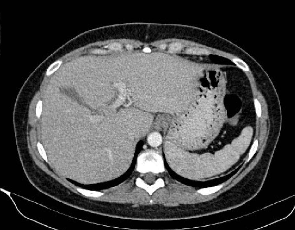 Fig. 6: En este caso no se consiguió una buena repleción del estómago y no es posible identificar ninguna lesión.