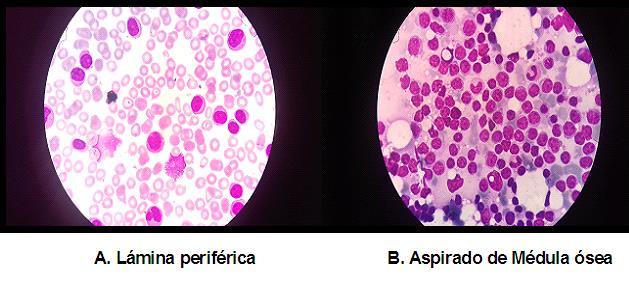 4 Figura. Microscopía óptica de una leucemia linfoide crónica transformada en leucemia linfoide aguda. A. Lámina periférica, B.