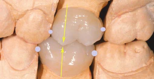Por distal con la cara mesial del 2º molar, el surco mesio-vestibular del 1º molar inferior corresponde con la cúspide