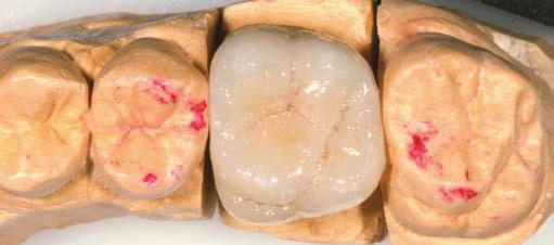 Angle Clase I: el surco mesio-vestibular del 1º molar inferior corresponde con la cúspide mesio-vestibular del 1º molar