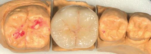 Caras oclusales (Figuras 64-66) El 1/3 mesial de la cara oclusal del 1º molar inferior contacta con la 1/2 distal de la cara
