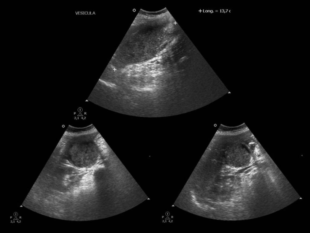 Fig. 2: Mujer de 68 años, con leucocitosis, dolor abdominal y vómitos atendida en urgencias.
