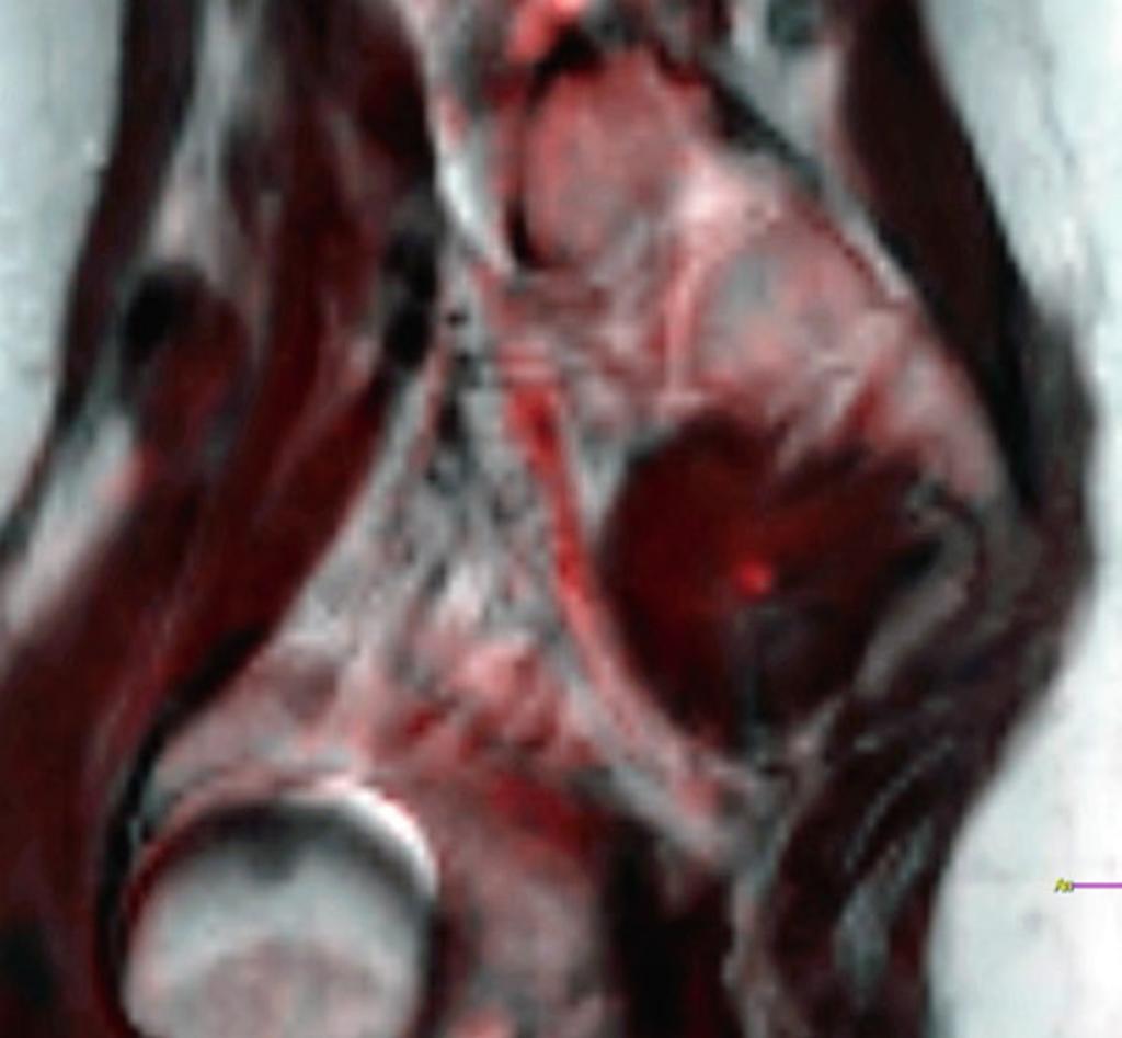 Fig. 11: Aquisición sagital DTI del agujero ciático mayor en el que se visualiza una compresión del nervio