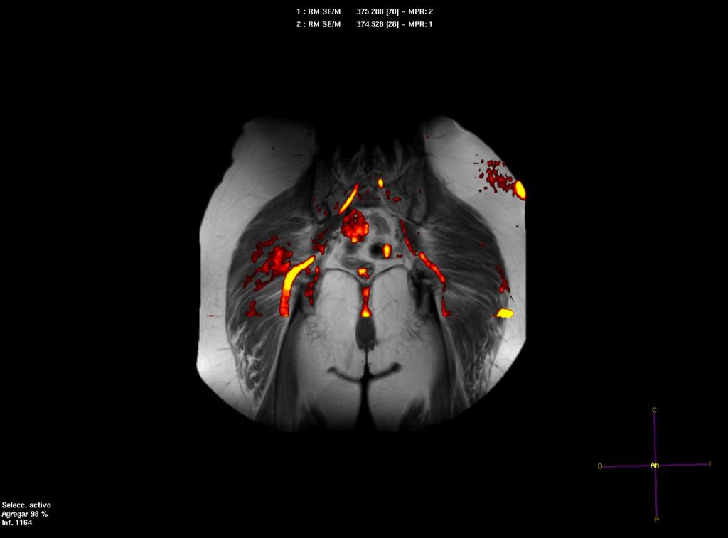 Fig. 3: Paciente con clínica de ciatalgia derecha, que en los estudios morfológicos no logró visualizar asimetrías significativas de grosor ni de intensidad de señal (paciente de la figura 1), en la