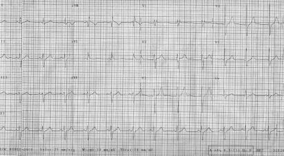 segmento ST en precordiales derechas V1-V2 con patrón tipo Brugada. Figura 6. ECG realizado 24 horas después de la cardioversión farmacológica.