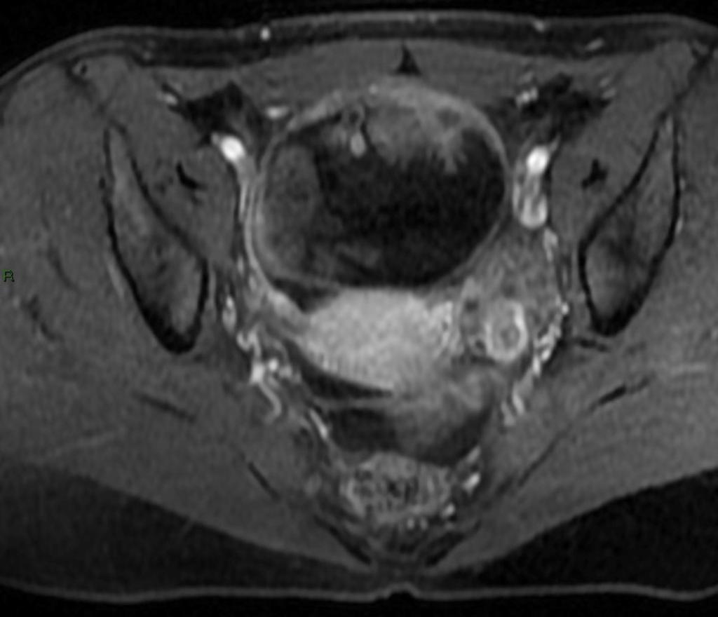 Fig. 10: Imagen obtenida mediante secuencias potenciadas en T1 60 segundos tras la administración de contraste IV, que muestra lesión