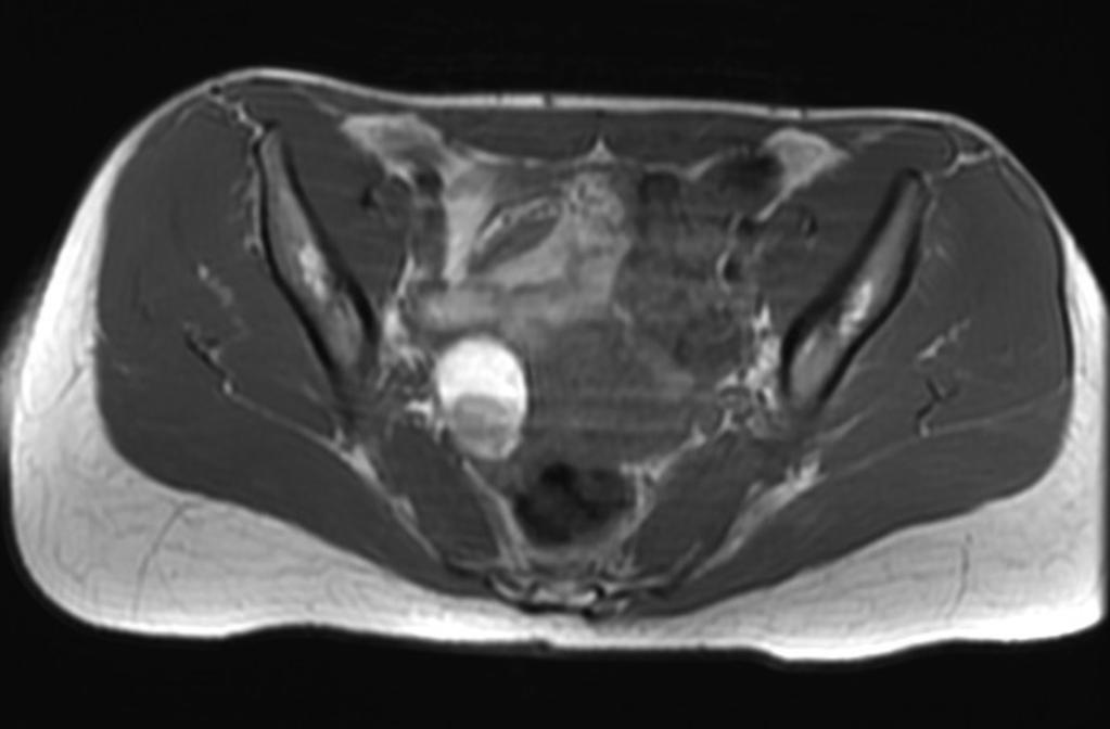 Fig. 1: La imagen muestra una lesión anexial derecha