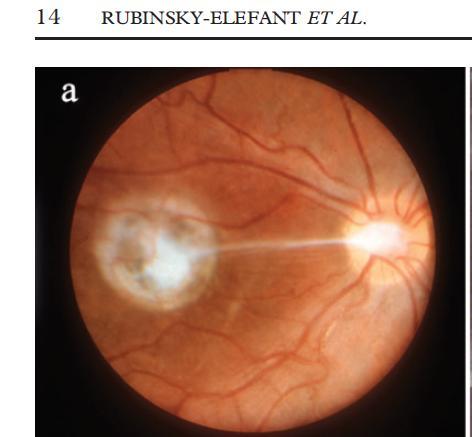 Diagnóstico Eosinofilia en la forma generalizada (rara en la ocular) Biopsia hepática (DD