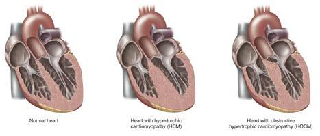 4 Disminución de la elasticidad del músculo cardíaco: el tipo de músculo que se genera con la MCH no es músculo normal; las fibras musculares toman una configuración anárquica que disminuye su