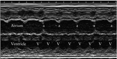 Taquicardia ventricular Discordancia frecuencia auricular (normal) de ventricular (180-300 lpm) Asociación a cardiomiopatía hipertrófica, tumores cardiacos, disfución canales iónicos Tratamiento sólo