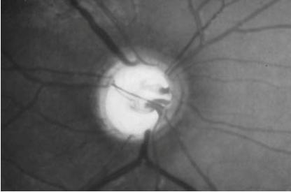 En el glaucoma se produce la alteración del nervio óptico con pérdida progresiva de la capa de fibras nerviosas (RFNL) y de las células ganglionares de la retina (CGR).