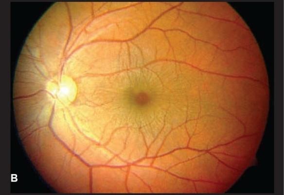 El examen oftalmoscópico indirecto reveló elevación coroidea periférica poco profunda.