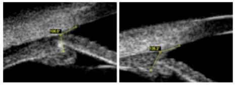 Figura 8. Comparación de ángulos del cuerpo ciliar corneal durante la fase aguda (lado izquierdo) y tras la retirada del tratamiento (lado derecho) (Végh et al., 2013).