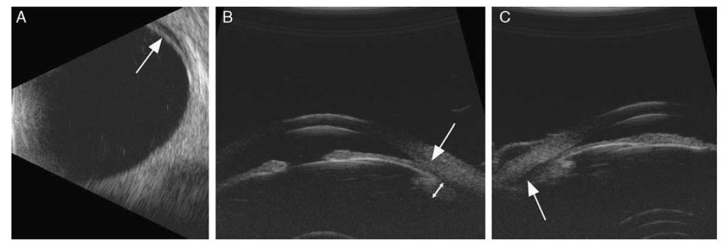 B, Biomicroscopia de ultrasonido (UBM) del segmento anterior mostrando cierre de ángulo de aposición (flecha) debido al desplazamiento anterior del complejo lente-iris diafragma.