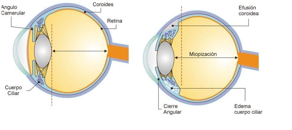 Con respecto al sistema ocular, la miopía aguda y glaucoma de ángulo cerrado son dos de los muchos efectos adversos de reacción idiosincrásica de algunos diuréticos, y el efecto subyacente que lo