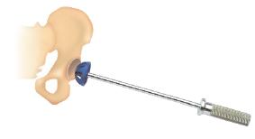 Técnica Quirúrgica Surgical Technique Fig. 1 Fig. 3 Fig. 2 Fig. 4 1 Colocación del paciente y vía de abordaje Posición en decúbito lateral o supino según las preferencias del cirujano.