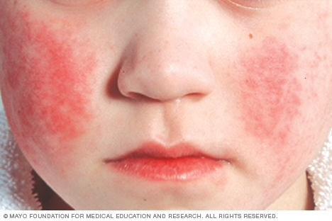 Parvovirus B19 Eritema infeccioso o 5ta enfermedad: manifestación tipica en niños Fiebre, CEG, rash facial característico Adultos Asintomáticos o