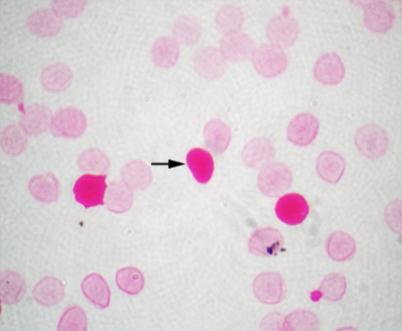 Hemorragia Feto-materna Kleihauer-Betke Identificación de Hb fetal (adulto 1% Hb fetal) GR maternos solución ph ácido GR adulto fantasma Hb cruza membrana GR fetal rosado