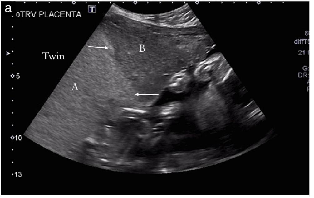 Secuencia anemia policitemia Feto donante A: Hiperecogénico feto donante B: Hipoecogénico feto