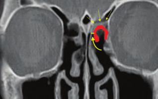 Una técnica quirúrgica de la Universidad de Medicina de Graz 15 Las imágenes tomográficas posoperatorias (Figs.