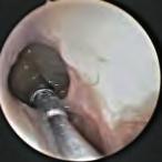 Aún permanecen restos craneales de la lámina de la bulla, el ostium del seno frontal no se ve. En la Fig.