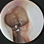 seno frontal. El endoscopio de 45 se introduce en el meato medio y se emplaza debajo de la lámina de la bulla (Fig.