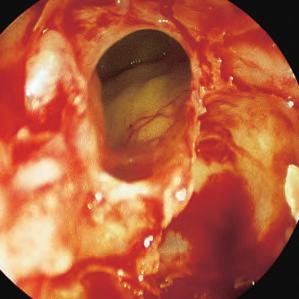 Una técnica quirúrgica de la Universidad de Medicina de Graz 25 Caso 2 Lado derecho del paciente: el endoscopio de 45 se ha introducido debajo del cornete medio en el meato medio, detrás de la
