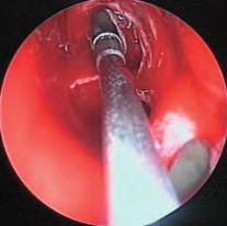 Una técnica quirúrgica de la Universidad de Medicina de Graz 27 Caso 3 Visión de un receso frontal del lado izquierdo con un endoscopio de 45.