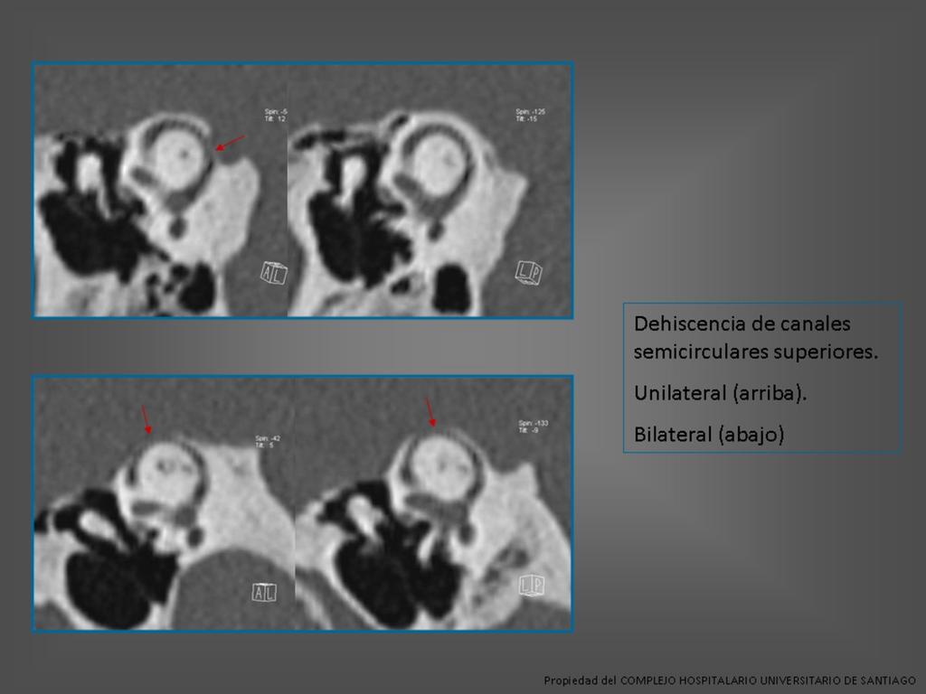 Fig. 9: Dehiscencia del canal semicircular superior en dos pacientes distintos.