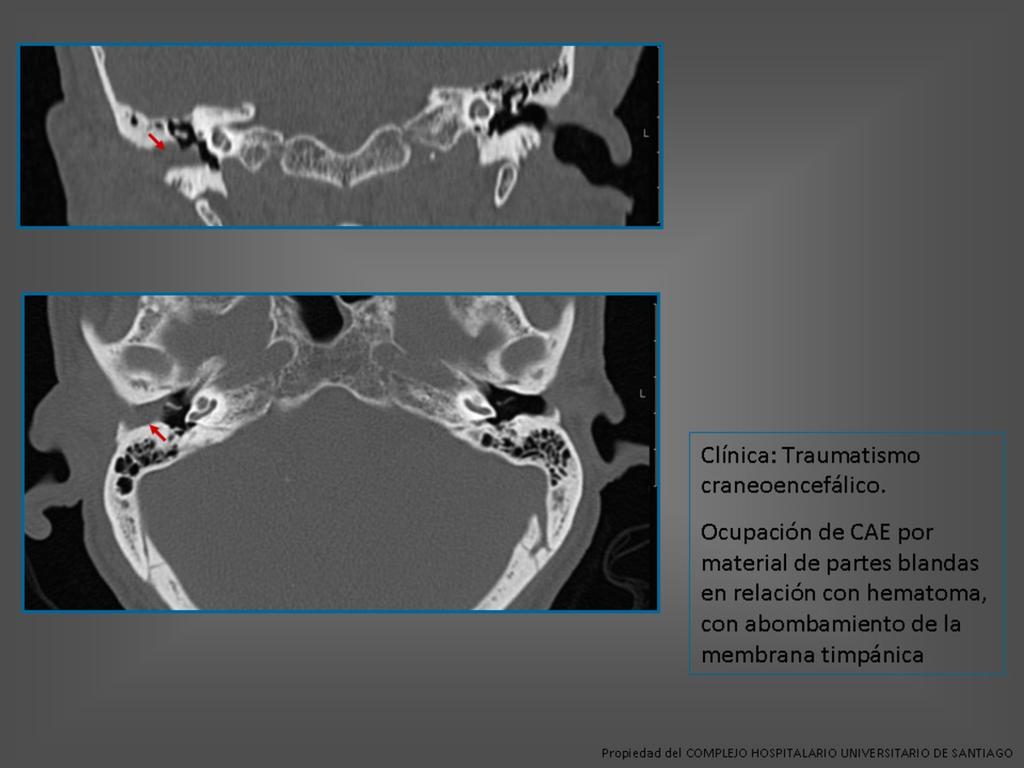 Fig. 13: Hematoma en CAE En el oído medio la estructura más frecuentemente afectada son los huesecillos.