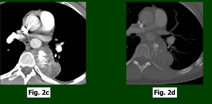 Figura 2c imagen axial de CT con la administración de medio de contraste, ventana de tejidos blandos y Figura 2d en ventana ósea, muestra las