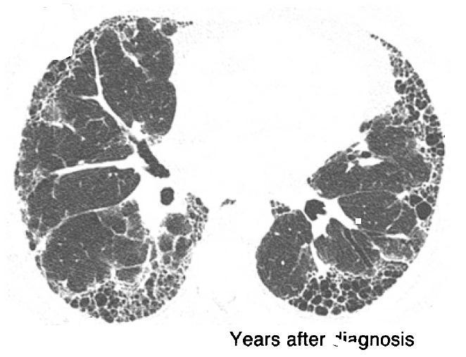 Fibrosis pulmonar idiopática FPI Adaptado