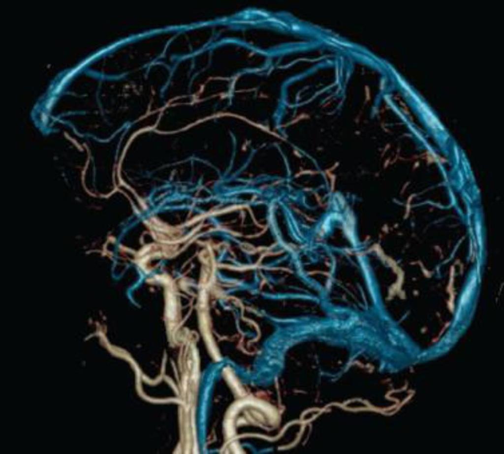 Fig. 12: Angiografía cerebral directa References: www.dsct.com 5.2 Tórax La evaluación de la perfusión pulmonar es una de las principales aplicaciones de la energía dual en tórax.