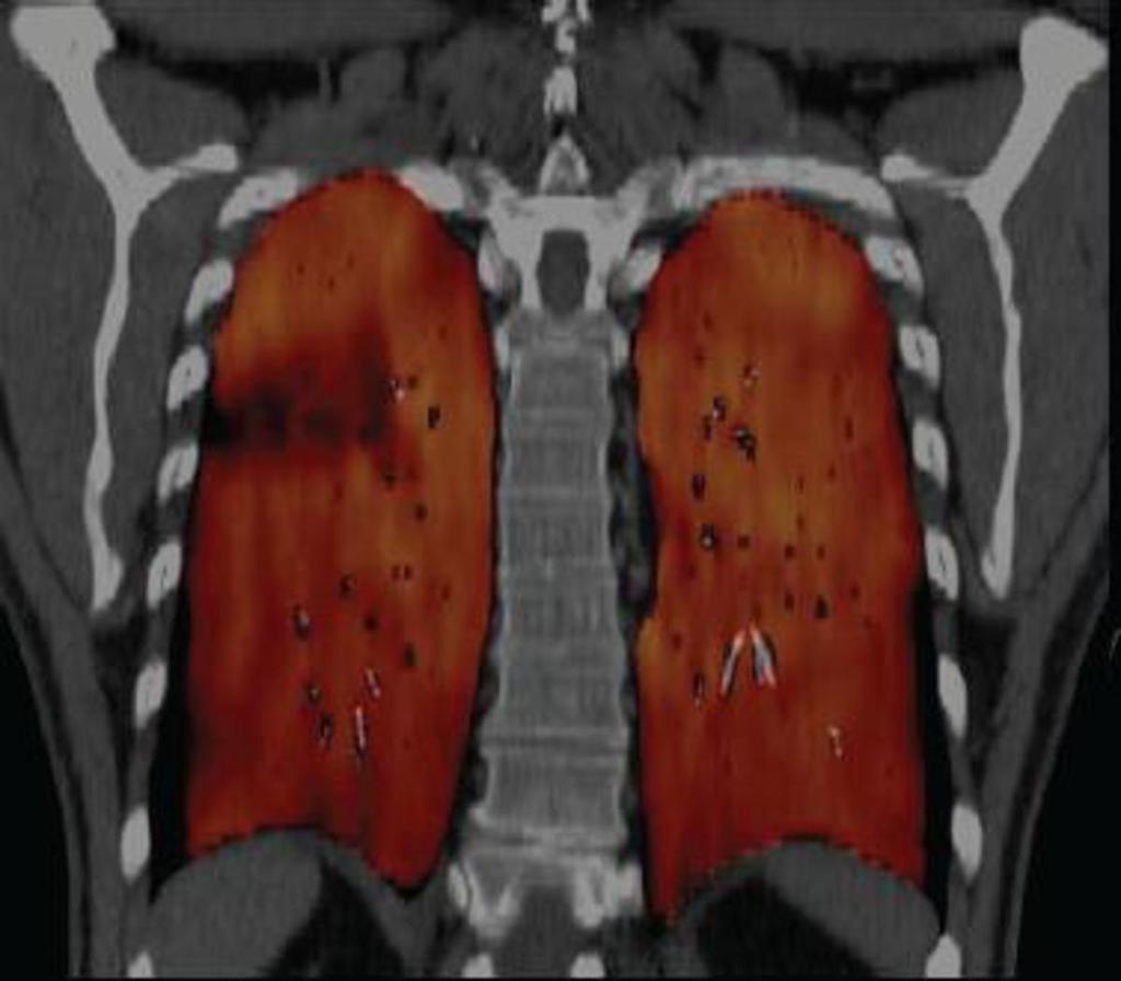 Fig. 13: Perfusión pulmonar References: www.dsct.